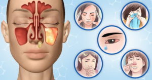 Sinüzit nedir? Sinüzit nedir?