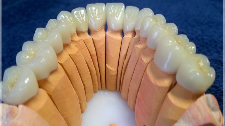 Zirkonyum Kaplama Diş İle Gülüş Tasarımı