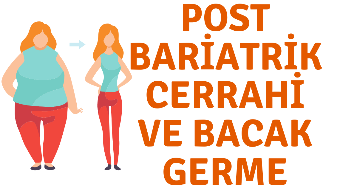 Post Bariatrik Cerrahi ve Bacak Germe