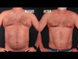 Liposuctionla İdeal Bedene Kolay Ulaşın