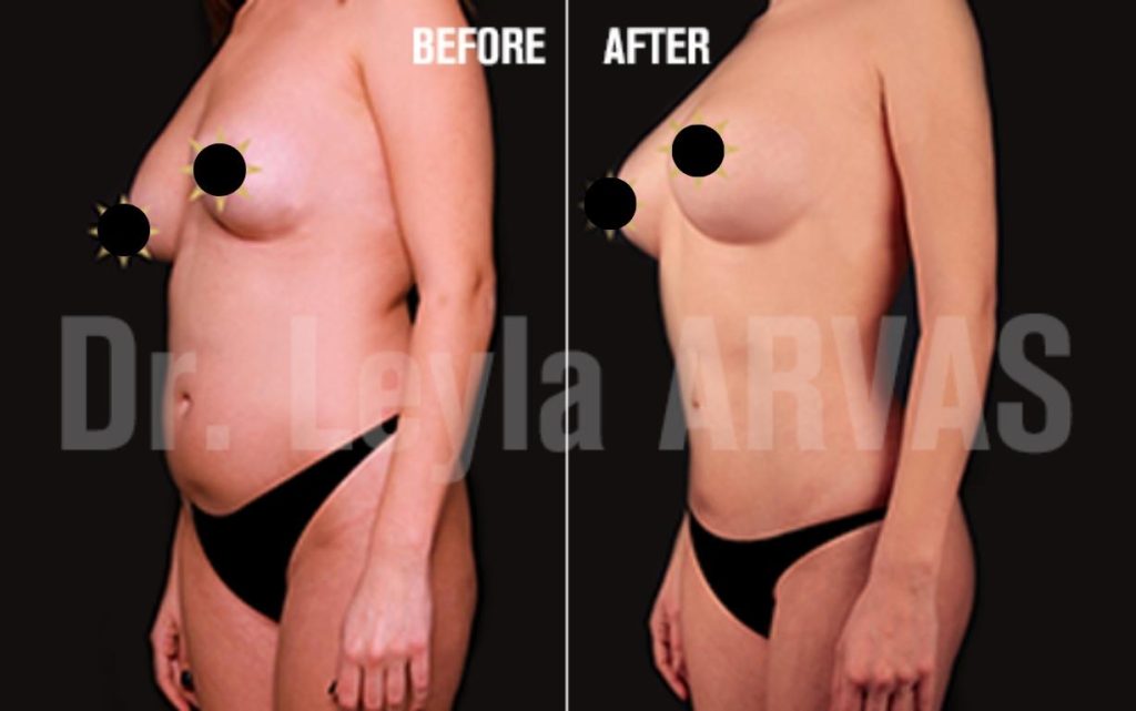 Liposuctionla İdeal Bedene Kolay Ulaşın